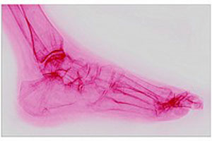 Osteoporosis - Foot Fracture