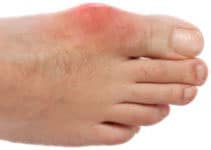 gout - painful toes
