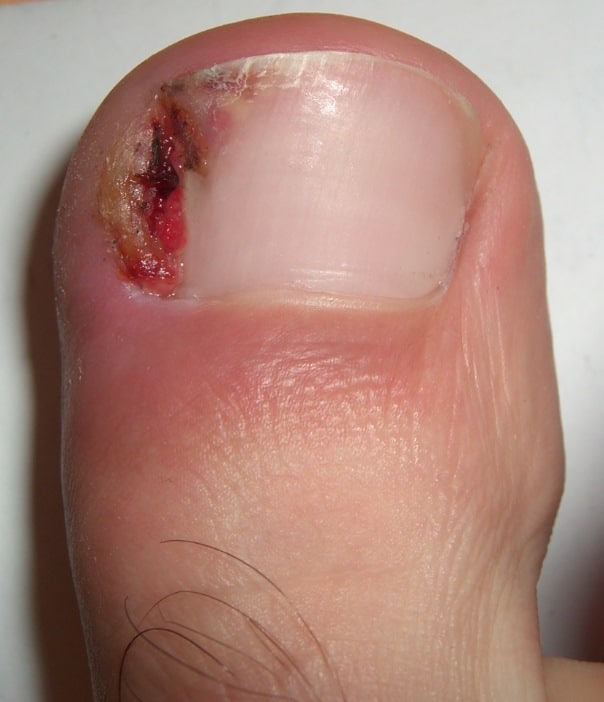 Toe Nail Abnormalities - Ingrown Toenail | Dr. K. Naftulin Podiatrist