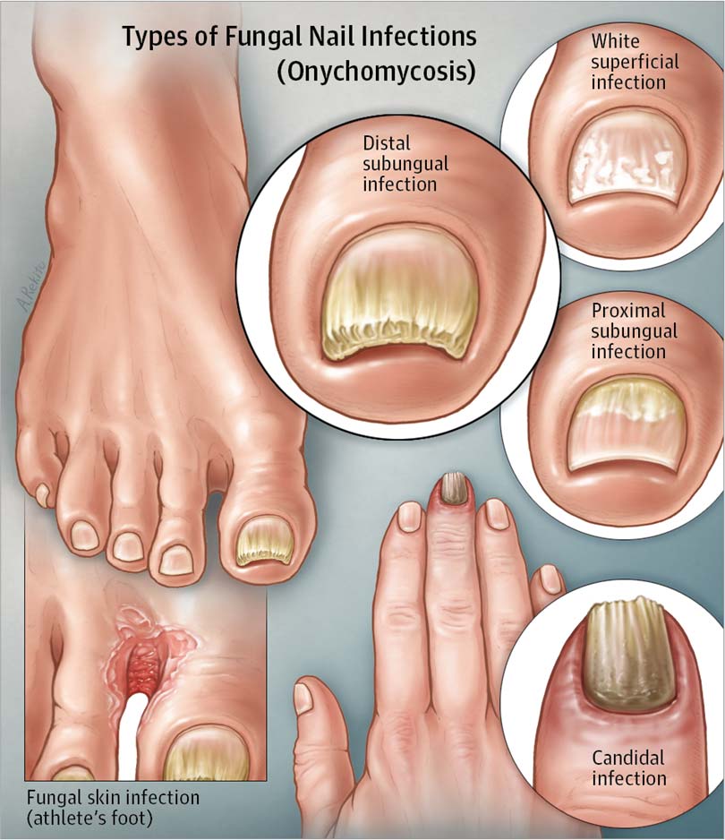 Fungal nail infection? - Excilor Solution