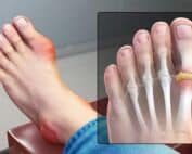 Gout | Foot Care