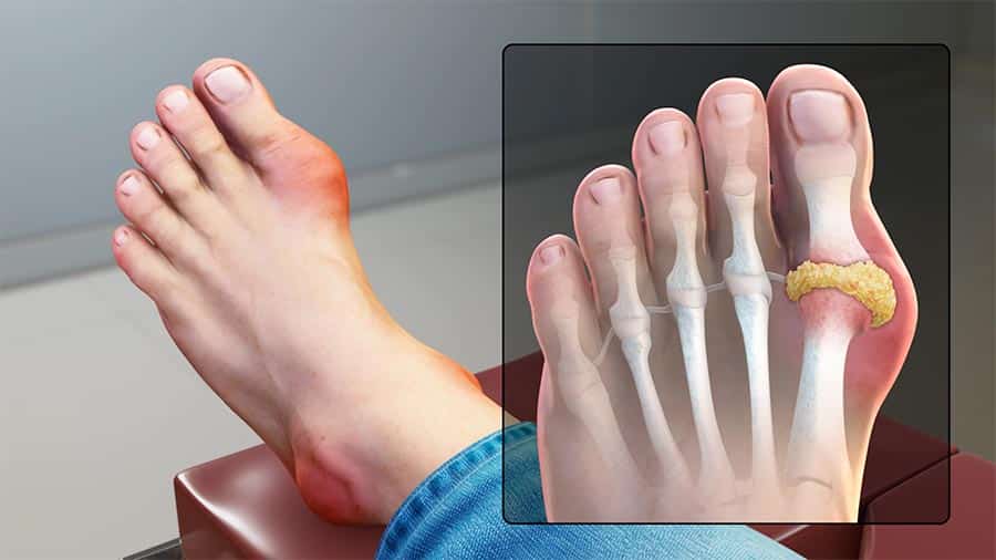Gout | Foot Care